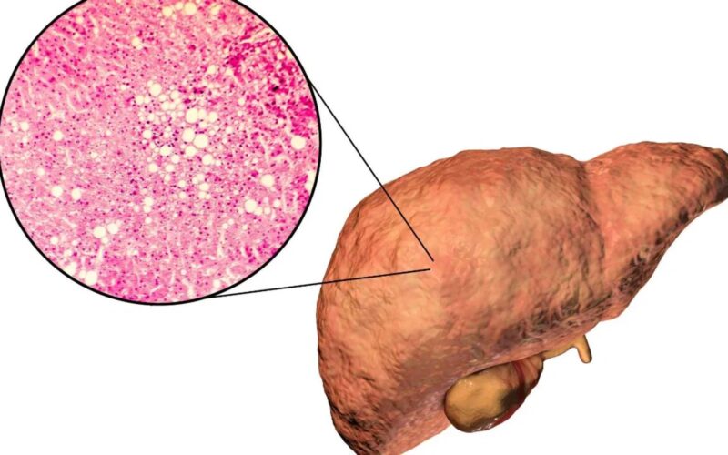 ਫੈਟੀ ਲਿਵਰ ਨੂੰ ਹਲਕੇ ‘ਚ ਨਾ ਲਓ, ਸਮੇਂ ਸਿਰ ਇਸਨੂੰ ਕੰਟਰੋਲ ਕਰੋ