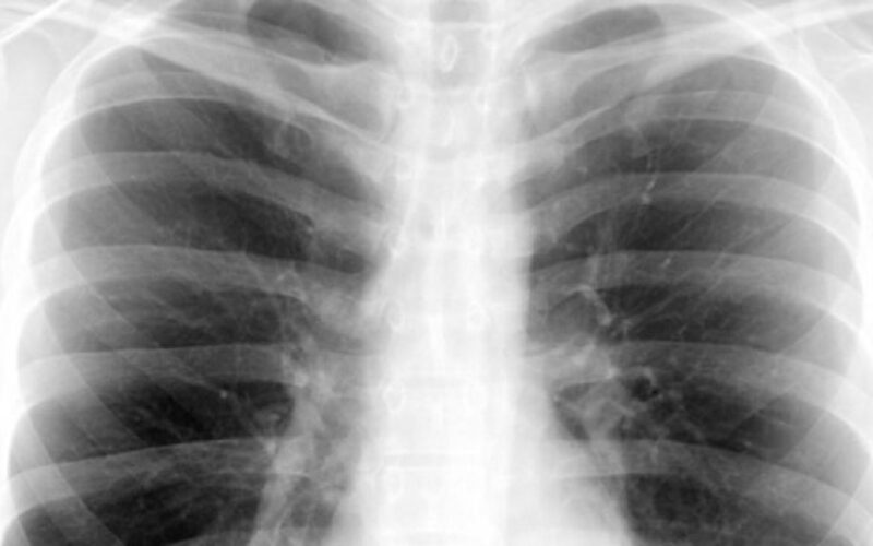 ਫੇਫੜਿਆਂ ਦੀ ਲਾਗ: ਵਧ ਰਹੇ ਜੋਖਮ ਤੇ ਉਨ੍ਹਾਂ ਨੂੰ ਰੋਕਣ ਦੇ ਤਰੀਕੇ