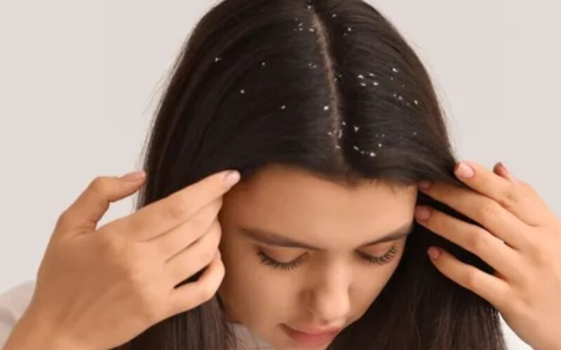 ਵਾਰ-ਵਾਰ ਡੈਂਡਰਫ? ਇਹ ਕਿਸੇ ਗੰਭੀਰ ਬਿਮਾਰੀ ਦਾ ਚੇਤਾਵਨੀ ਹੋ ਸਕਦਾ ਸੰਕੇਤ