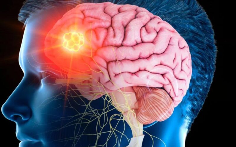 ਬ੍ਰੇਨ ਸਟ੍ਰੋਕ ਦੇ ਤੇਜ਼ੀ ਨਾਲ ਵੱਧ ਰਹੇ ਮਾਮਲੇ, ਜਾਣੋ ਇਸਦੇ ਲੱਛਣ ਤੇ ਇਸਨੂੰ ਰੋਕਣ ਦੇ ਮਹੱਤਵਪੂਰਨ ਤਰੀਕੇ